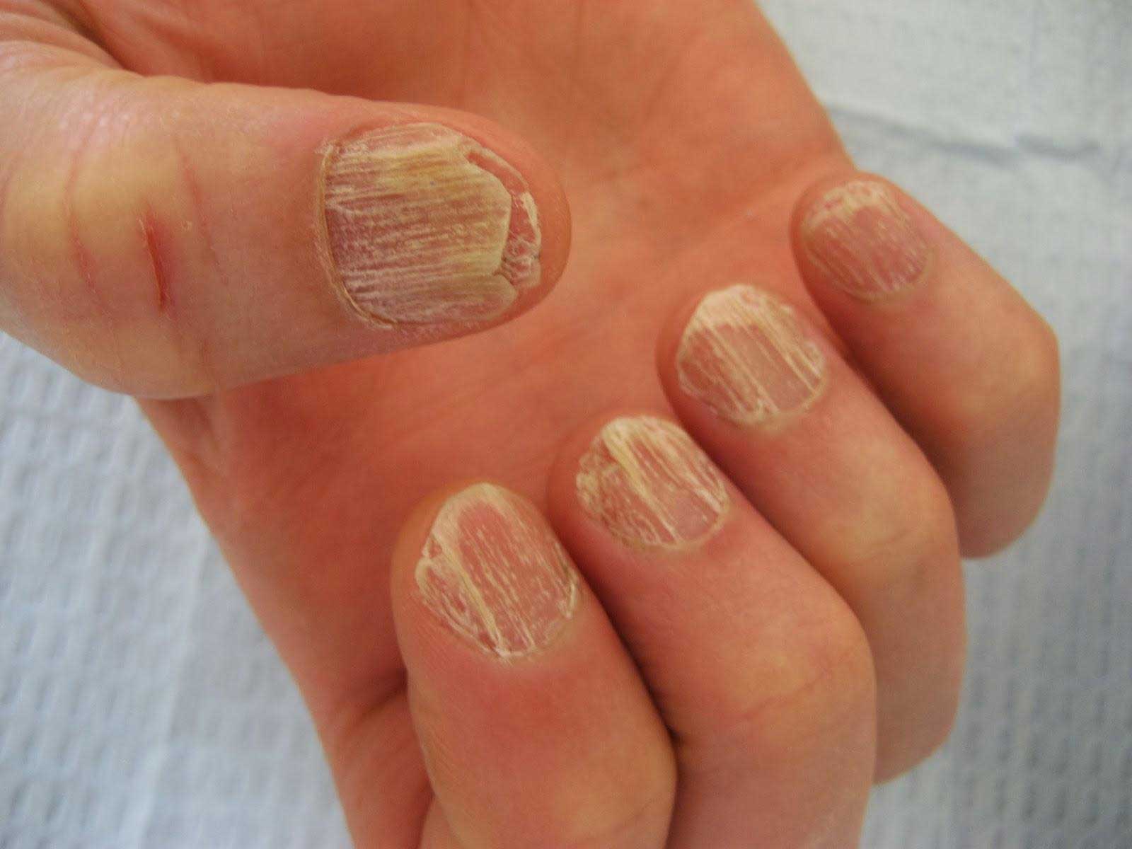 fingernails affected by nail fungus