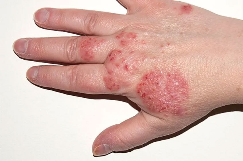 hand with eczema infection