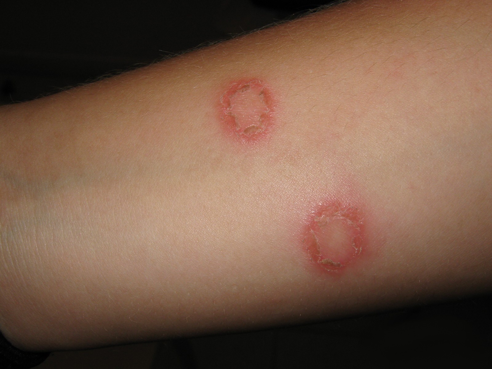 tea-tree-oil-ringworm